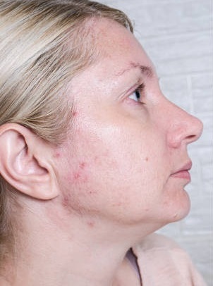 Young woman before and after anti acne treatment, skincare and dermatology concept.