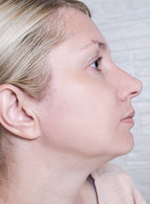 Young woman before and after anti acne treatment, skincare and dermatology concept.